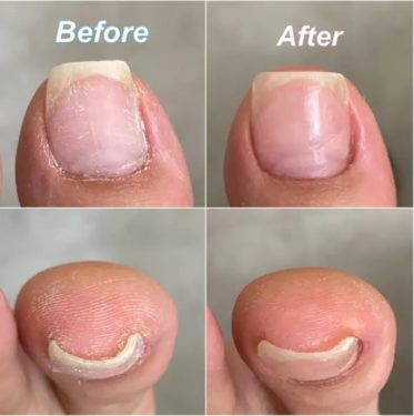 06-1　巻爪矯正　育成前・結果